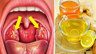 How to Cure Tonsillitis Fast and Naturally [upl. by Berny]