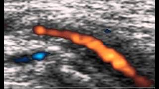 Temporal Arteritis Horton 2 [upl. by Dearden]