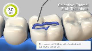 How to use iBOND Universal in total etch selective enamel etch and selfetch technique EN [upl. by Rois]