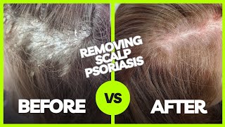 Removing Plaque Scalp Psoriasis  Using The AntiFungal Bundle myhappyscalpcom [upl. by Enyaz]