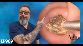 The MOST SATISFYING ring of dry ear wax removal EP989 [upl. by Ena610]