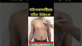 Gynecomastia Surgery  35k Campaign in Bangladesh  Gynecomastia Treatment [upl. by Eillo866]