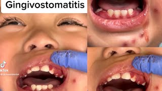 Herpetic Gingivostomatitis in Kids [upl. by Ellenehs]