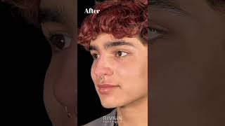 Before and After Non Surgical Nose Job nonsurgicalrhinoplasty [upl. by Aron]