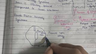 Papilloidema theory examination notes AK KHURANA [upl. by Adnauqahs733]