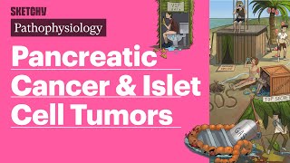 Pancreatic Cancer amp Islet Cell Tumors Pathophysiology  Sketchy Medical [upl. by Alurta164]