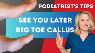 DIY Callus Care for Big ToePodiatrists Guide [upl. by Klinges113]