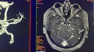 Malformación arteriovenosa asociada a hemorragia parenquimatosa y trombosis venosa… Fusión 3D [upl. by Tena]