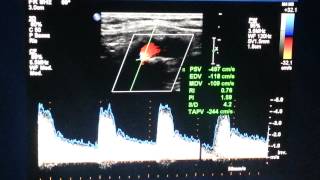 Carotid bruit high grade stenosis [upl. by Samuela]