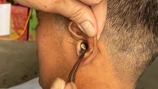 Removing ear blockage use manual tools [upl. by Vacuva]