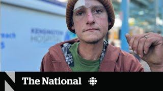 How a fleshrotting ‘zombie drug’ is complicating the overdose crisis [upl. by Yuh]