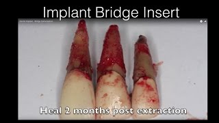 Dental Implant  Bridge Cementation [upl. by Barlow]