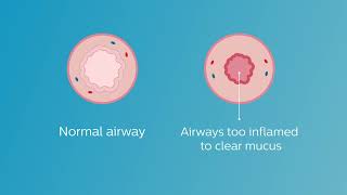 RespirTech Bronchiectasis Animation Video [upl. by Ahsenal821]