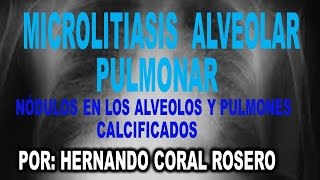 MICROLITIASIS ALVEOLAR PULMONAR  NÓDULOS EN LOS ALVEOLOS Y PULMONES CALCIFICADOS [upl. by Naut]