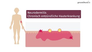 Was ist Neurodermitis und wie kann man sie behandeln [upl. by Dibbrun]