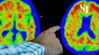 Lilly drug slows Alzheimers progression by 35 in trial [upl. by Elem]