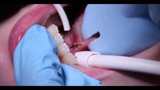 Precise SHP  Frenectomy [upl. by Jerri]