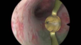 Rollerball Endometrial Ablation  Virtual Reality Simulation for Endoscopic Surgery [upl. by Enitsej744]