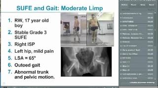 Gait kinematics and radiographic deformity following Slipped Upper Femoral Epiphysis [upl. by Ted]