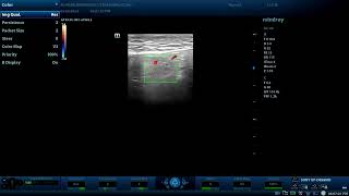 Incarcerated Inguinal Hernia  Diagnostic ultrasound cases [upl. by Lindsley108]