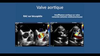 Echographie cardiaque transthoracique lessentiel a comprendre pour liECN [upl. by Sprage321]