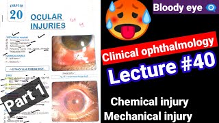 🔴Clinical ophthalmology lectures 40 ocular injuriesmechanicalchemical injury Contusion Hypema [upl. by Asilam]