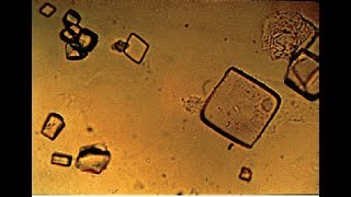 Urate crystals in Urine [upl. by Averill]