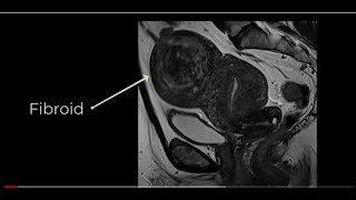 Subserosal Leiomyoma [upl. by Nevlin]