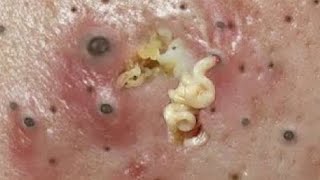 Big Cystic Acne Blackheads Extraction Blackheads amp Milia Whiteheads Removal Pimple Popping 234 [upl. by Mikah]