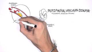 Cardiovascular Disease Overview [upl. by Neraa947]