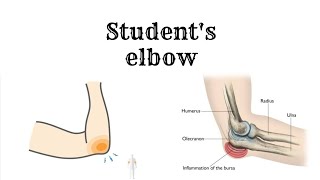 Everything about STUDENTS ELBOW in just 2 minutes [upl. by Raphael]