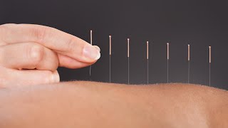 The Science Behind How Acupuncture Helps Relieve Pain A Doctor Of Chinese Medicine Explains [upl. by Retsev]