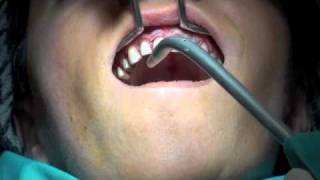 periodontal flap operasyonu [upl. by Alvarez]