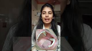 OperculectomyPericoronectomy ✅🦷✨ shortsviral dentistdoctor ytshorts shortvideo youtubeshorts [upl. by Revned]