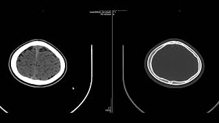 case 11b  CT of the case 11a [upl. by Styles]