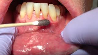 Dr Laurence Rifkin Treatment of Mouth Ulcer [upl. by Ayim906]