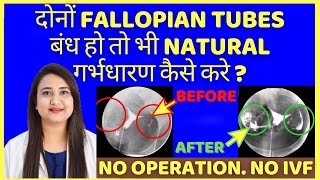 FALLOPIAN TUBES बंध हो तो भी NATURAL गर्भधारण कैसे करे  FALLOPIAN TUBE BLOCKAGE [upl. by Winton104]