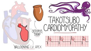 Takotsubo Cardiomyopathy Explained Broken Heart Syndrome [upl. by Adnileb545]