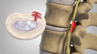 Herniated Disc  Patient Education [upl. by Refiffej]