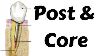 Post amp Core post preparation procedure in endodontic amp prosthodontics Step by step Dentsply calibra [upl. by Mahalia]