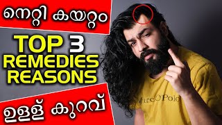 Top 3 Remedies amp Reasons For Frontal Hairloss  Hair Thinning  Balding  Haircare  DHT  LHG [upl. by Py]