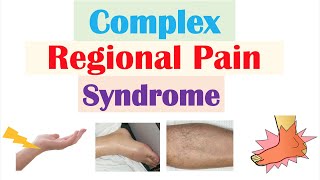 Complex Regional Pain Syndrome  Causes Pathophysiology Signs amp Symptoms Diagnosis Treatment [upl. by Reena682]