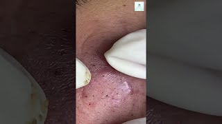 Big Cystic Acne Blackheads Extraction Blackheads amp Milia Whiteheads Removal Pimple Popping shorts [upl. by Hadleigh]