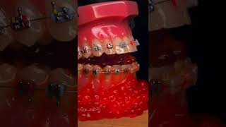 Braces ASMR The Chewy Crunchy Sounds of Jaw Braces [upl. by Nidorf]