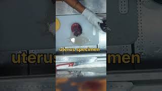 Uterus specimen grossing tissuefixation kidneydisorder cystickidneydisease [upl. by Adliw]