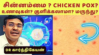 Chickenpox Causes Symptoms and Prevention  சின்னம்மை [upl. by Dnalloh]