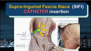 SupraInguinal Fascia Iliaca SIFI Catheter Insertion  the SUPRAINGUINAL approach [upl. by Annanhoj]