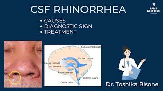 CSF rhinorrhea  causes  Diagnostic signs  Treatment [upl. by Attalanta]