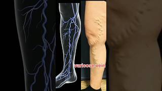 Varicose veins and treatment [upl. by Nnaecarg811]