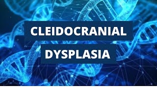 Cleidocranial Dysplasia Introduction Etiology Clinical Features and Treatment [upl. by Reece]